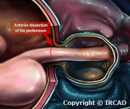 Traitement Laparoscopique Des Volumineuses Hernies Hiatales Websurg The E Surgical Reference Of Laparoscopic Surgery Websurg The Online University Of Ircad