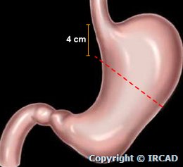 partial gastrectomy