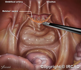 laparoscopic prostatectomy