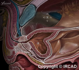 Hepatic and Skin Metastases after Laparoscopic Radical Prostatectomy for Prostate Cancer