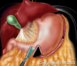 La Sleeve Gastrectomie  Polyclinique de la Thiérache