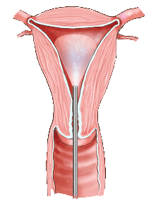 Hysteroscopy - initiation 