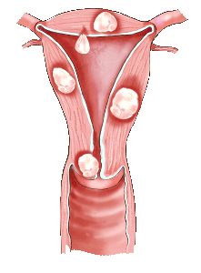 Complex or advanced surgery of the uterine cavity